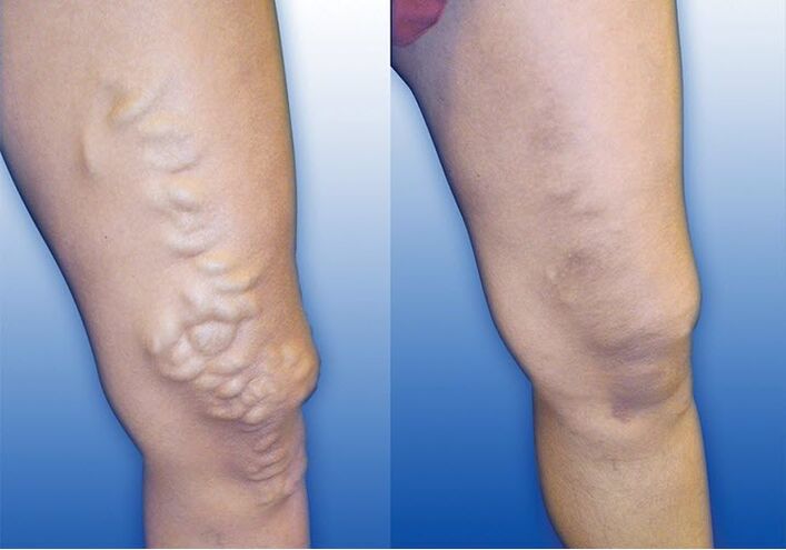 The cause of varicose veins