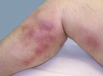 The complications of varicose veins