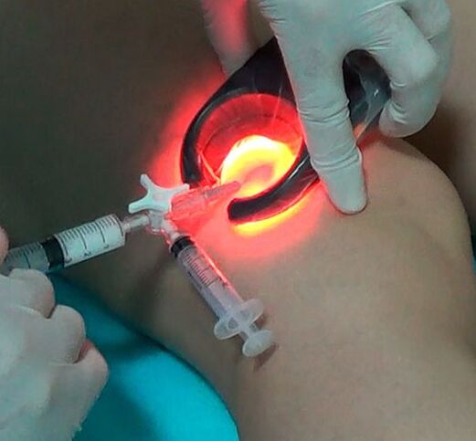 Varicose vein treatment