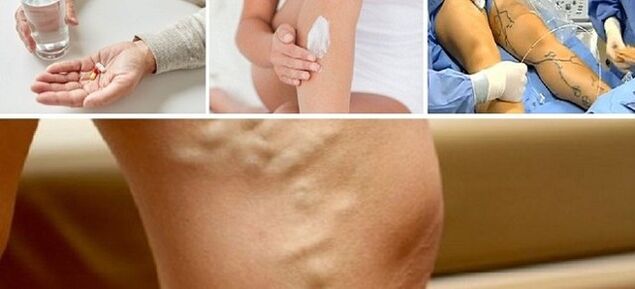 Varicose vein treatment