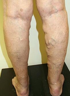 varicose veins on the feet