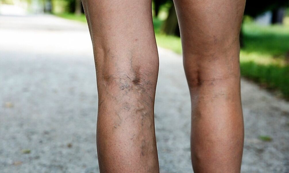 Expanded veins in the feet