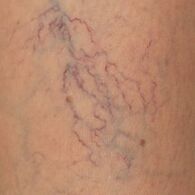 The manifestation of varicose veins