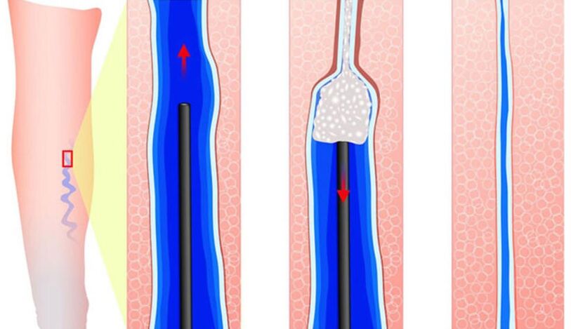 Sclerosant Introduction in Sclerotherapy
