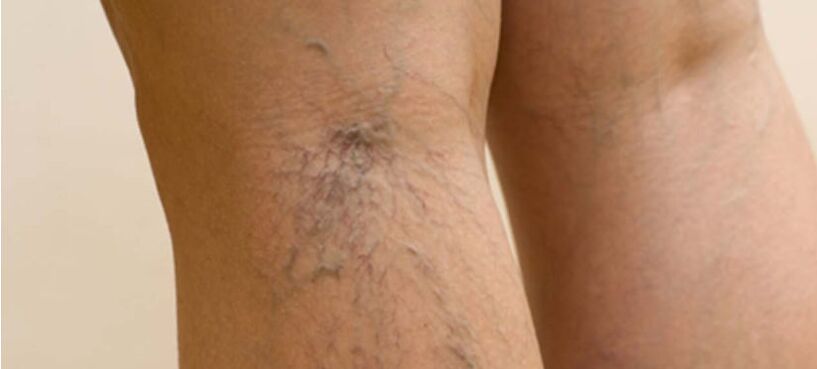 Varicose veins on the feet