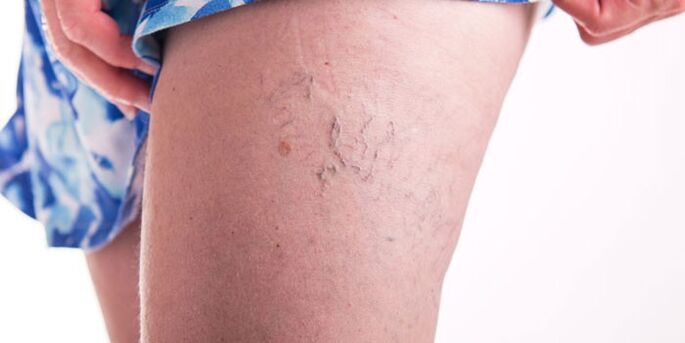 A way to treat varicose veins