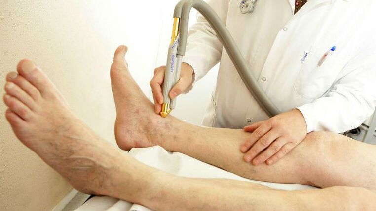 internal leg varicose veins