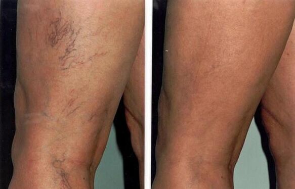 pictures before and after varicose vein treatment
