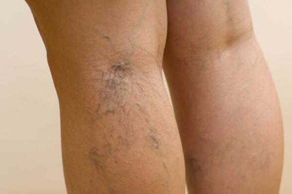 varicose veins in the legs