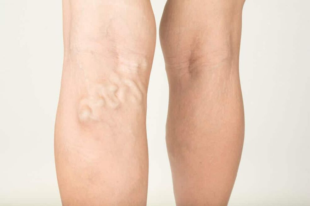 manifestations of varicose veins